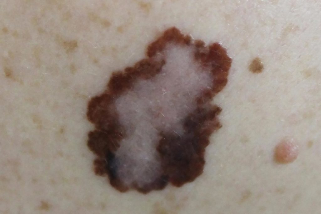 Boils, Cysts, Ingrown Hairs, and 11 Other Skin Mysteries Explained ...